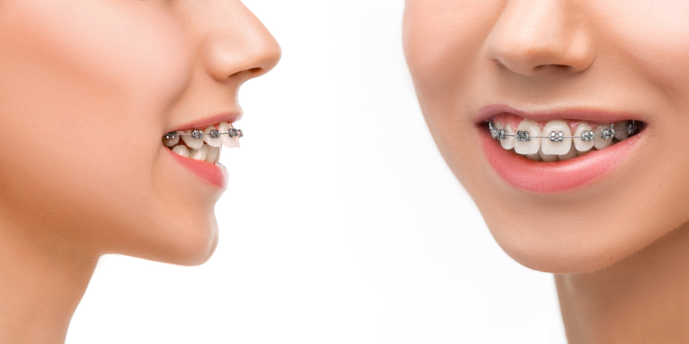 Can Braces Fix an Overbite?