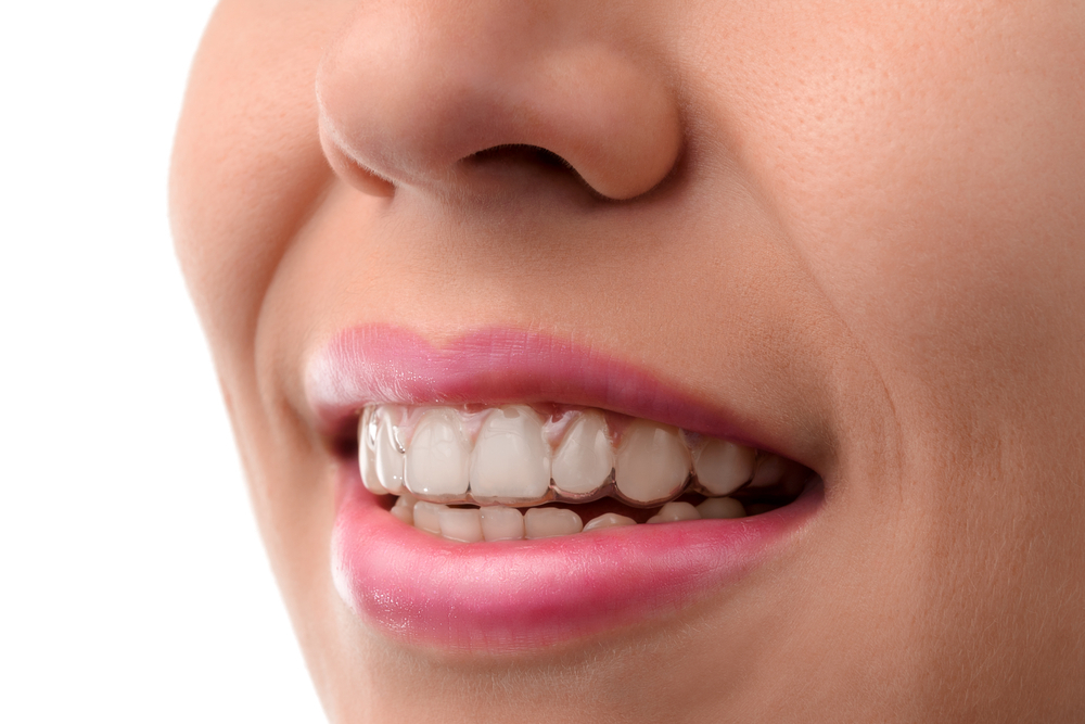 How Long Should You Wear Your Retainer After Braces?